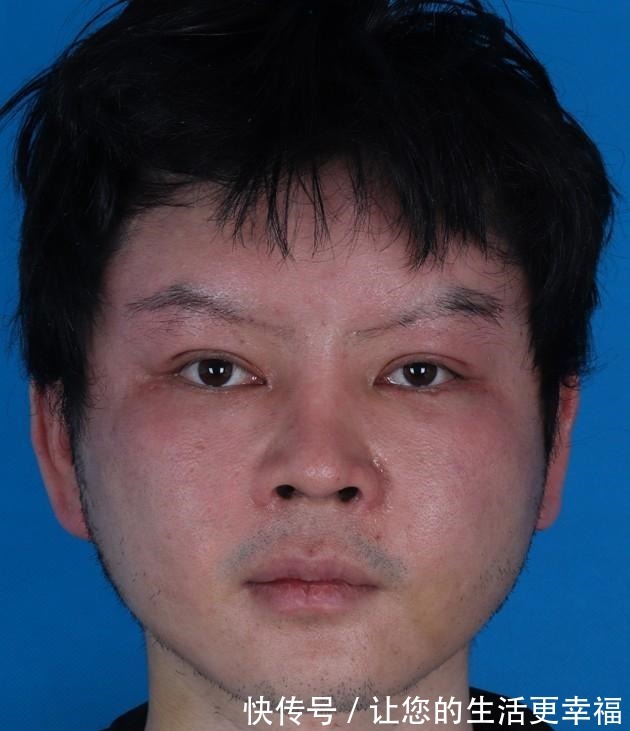 法令纹 32岁小伙子拉皮真实记录,术后30天效果很“惊艳”!
