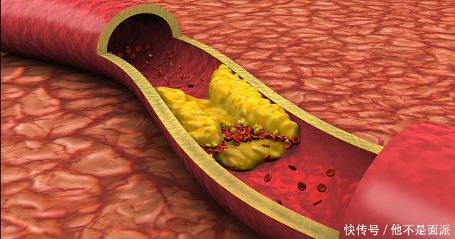 也会加剧血|每天吃玉米可以降血脂北大教授大错特错,真正降血脂的是一事