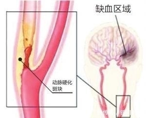 血管|颈动脉一旦被堵,这个部位反应最强烈,1种蔬菜汤,通血管消斑块