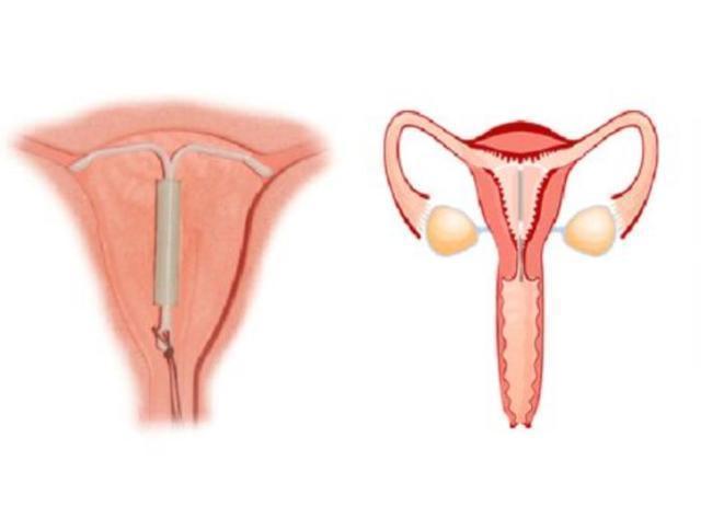 避孕药|各国避孕方式对比,以色列的这种避孕方式,相信大多数人都没听过