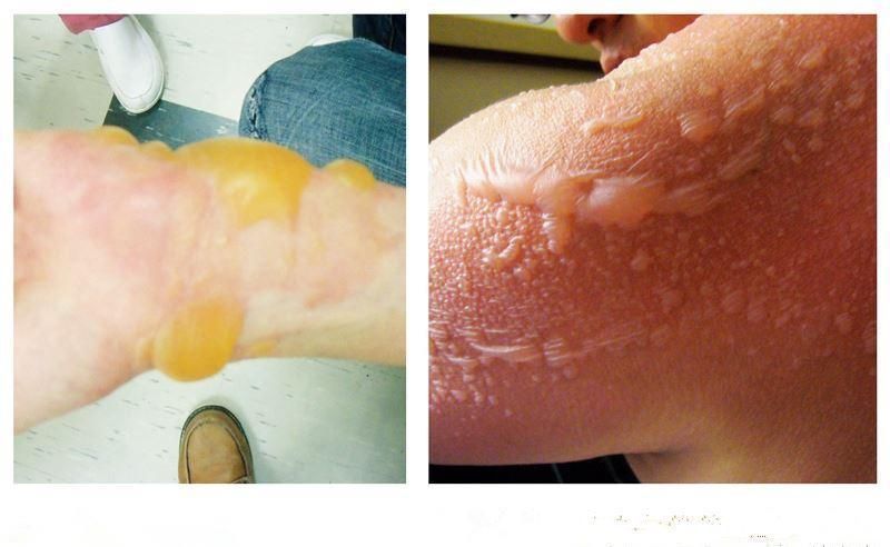 水泡|孩子烫伤后在家必做4步骤,别做4件事,照顾轻度烫伤注意5事项