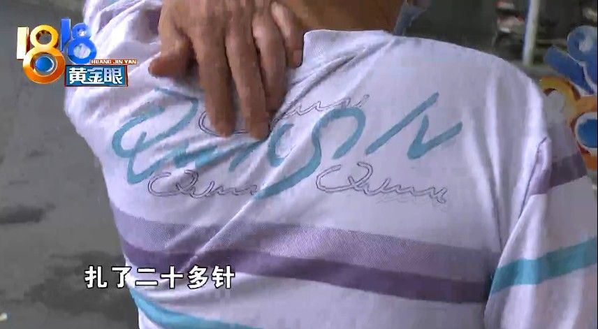 扭伤|针灸后查出来“气胸”，怀疑针灸扎到肺