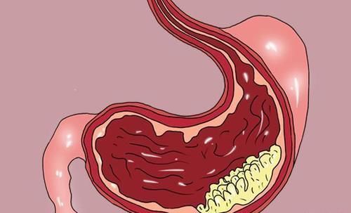 检查|胃癌有征兆,假如得了胃癌,饭后通常会出现3种不适,早点检查