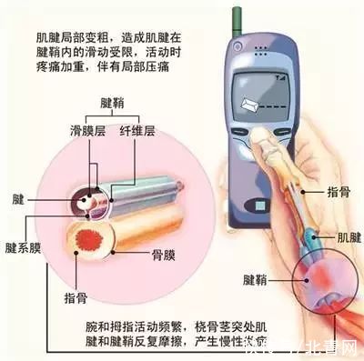 医生|1个动作自测有无腱鞘炎！医生教你4个方法摆脱它