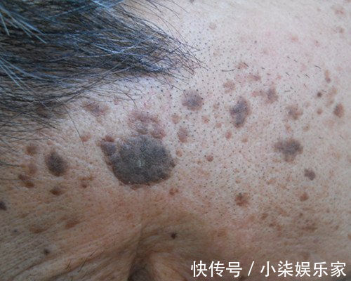 大蒜|老年斑太难看怎么办老奶奶教你3招，淡化20年斑，试过都说好