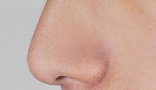 鼻子上挤出的白色丝状物,到底是啥?鼻子上的皮肤该如何清洁?