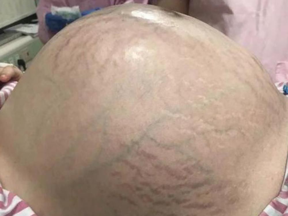 血管瘤|孕妇羊水过多,危及母婴安全!手术放出15斤羊水