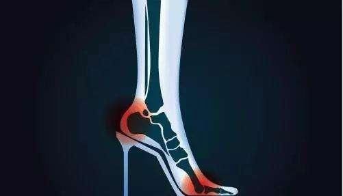 跟骨|足跟痛的5大原因,减轻跟腱对跟骨的拉力,而减轻病痛,建议了解