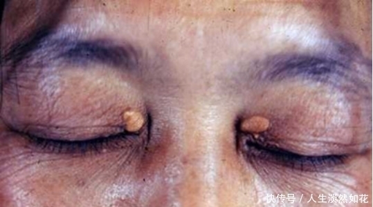 高血脂|“它”比肥肉胆固醇高23倍,很多人爱吃,提醒高血脂家人尽量少吃