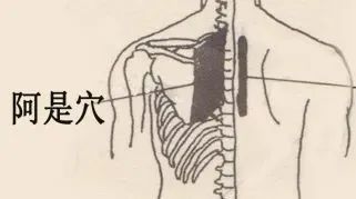 斑秃|国医大师贺普仁：火针治疗斑秃经验