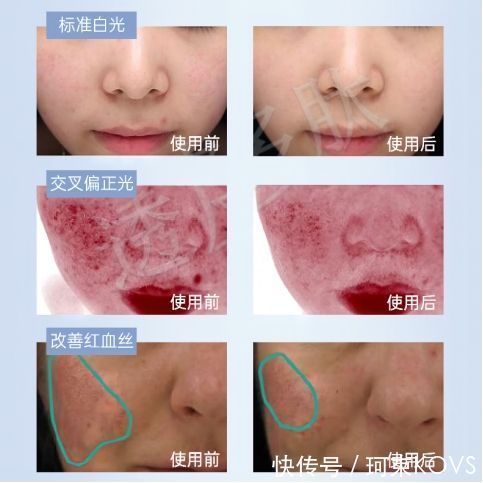 过敏反应 真相了,护肤品用得越多越勤皮肤可能越差