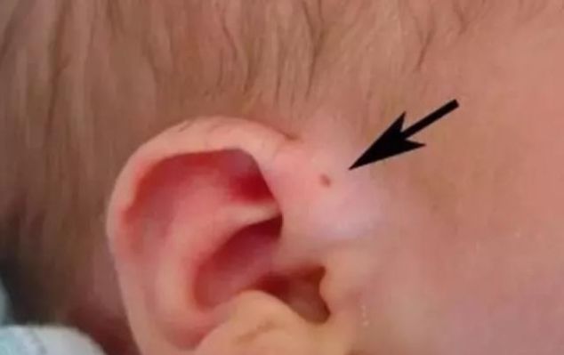 耳朵|孩子耳朵旁边长出“聪明孔”,奶奶好奇挤了一下,不料却惹了麻烦