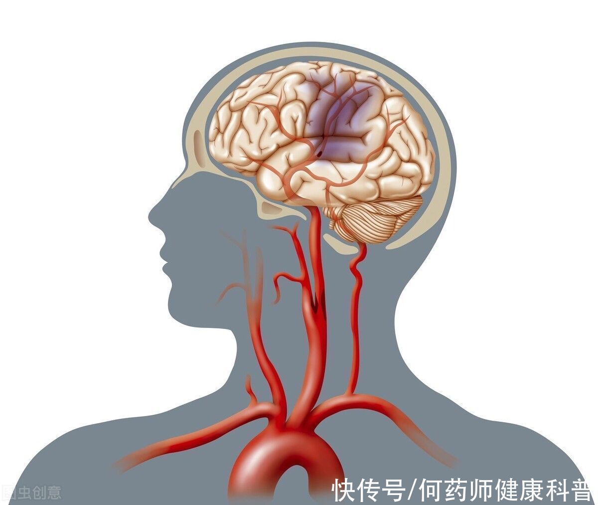  发现颈动脉内膜增厚、斑块，并不一定要服用他汀，6种情况要分清