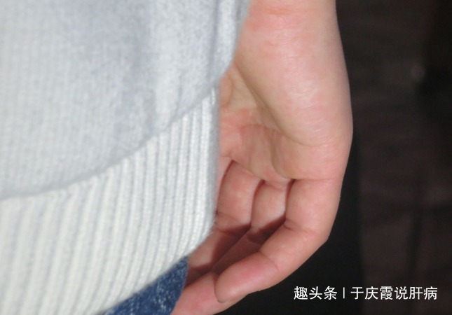 中指|女人肝不好,手上有3点异常,1个也没有,恭喜你