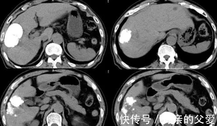 肝细胞|34岁女子因减肥,2个月后确诊肝癌,医生怒斥:1种水果要忌口,莫大意