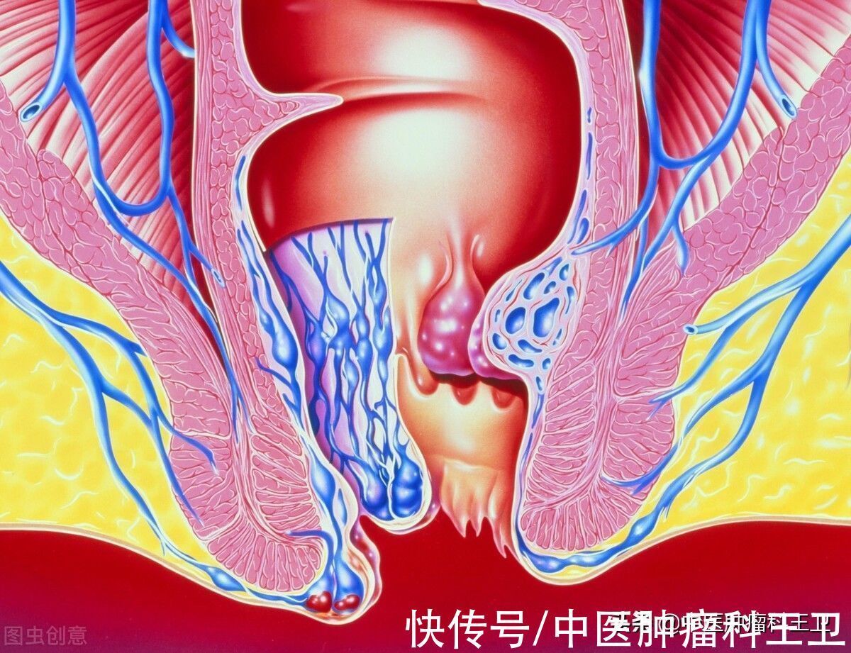 肠癌|中老年人最容易患癌！中医提示：出现这4种症状，千万别当成小事