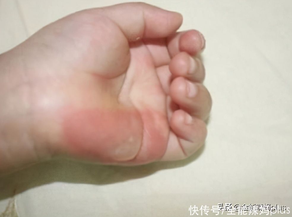 水泡|4岁娃掉入170度油锅,奶奶3步救下孩子,医生:比我内行