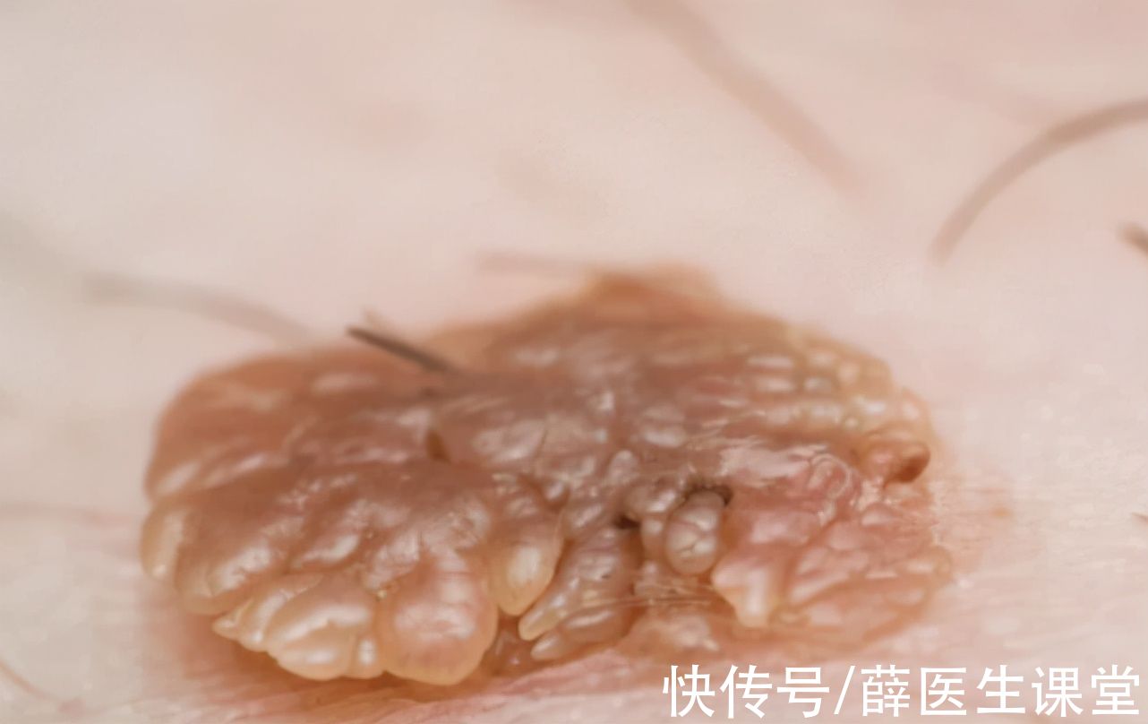 佳佳|17岁高中生被母亲传染HPV，医生：无知，这1物怎么能给孩子用