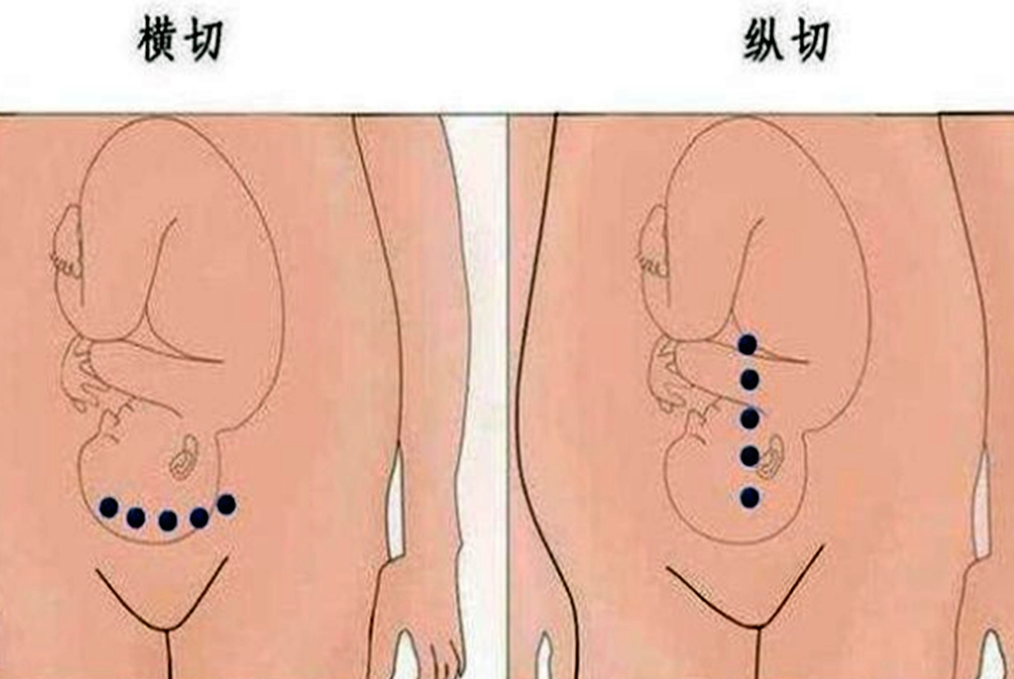 宝妈|“我没说要竖刀啊”,为什么剖腹产医院默认竖刀女性要提前了解