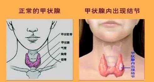 甲狀腺結(jié)節(jié)的“元兇”找到了，三物常端上餐桌，甲狀腺也會(huì)感謝你