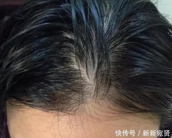 头发上有这“4个现象”,可能是长螨虫了,教你一招,轻松除螨