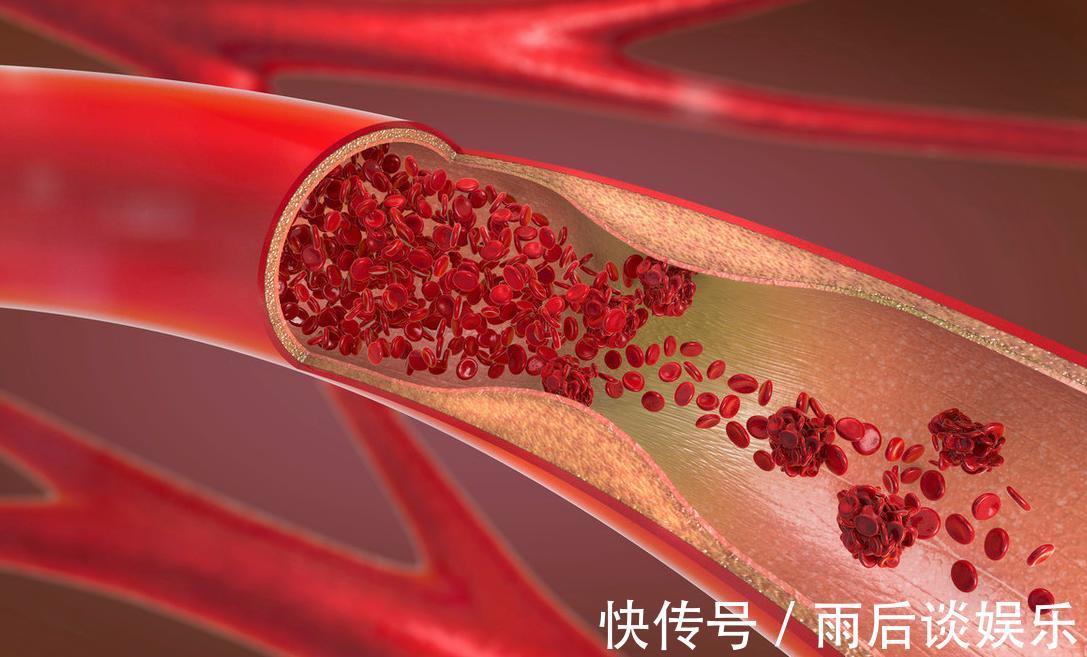 血管堵塞|高血脂不能碰牛奶吗?建议:2物还请管住嘴,益于血管健康