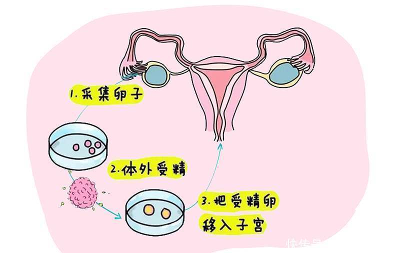 子宫|试管婴儿和人工授精怎么选？