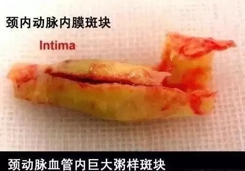 血液|德国颠覆性研究：动脉硬化斑块并非来自血液中的脂肪