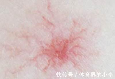 刘哥|身体2处“发痒”,别误以为是过敏,或是肝脏癌变发出的求救信号