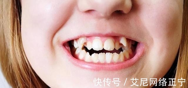 刷牙|17岁儿子长尖牙,亲妈吐槽像“吸血鬼”,网友:也可能是个狼人