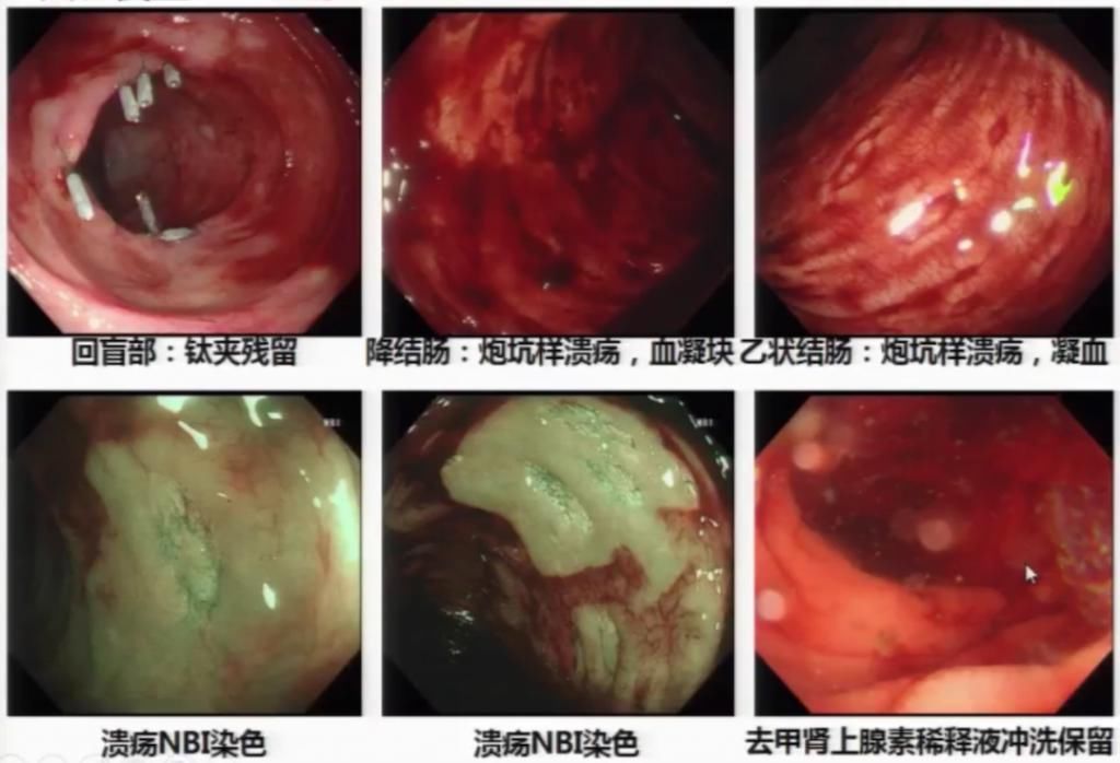 休克|反复便血十余天，一度出现失血性休克，原因竟然是……