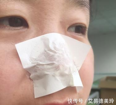 效果|鼻子上有黑头不要慌,涂上它5分钟后撕下,黑头被连“根”拔起