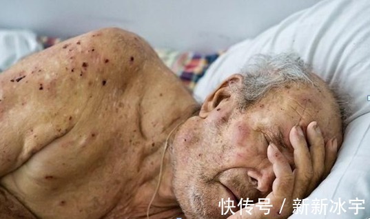 患者|癌症晚期的患者会遭受哪些痛苦,应该怎么办告诉你真相