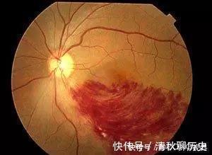 眼球|近视的眼球如同一个吹大的气球,近视度数越高,气球越大,越危险