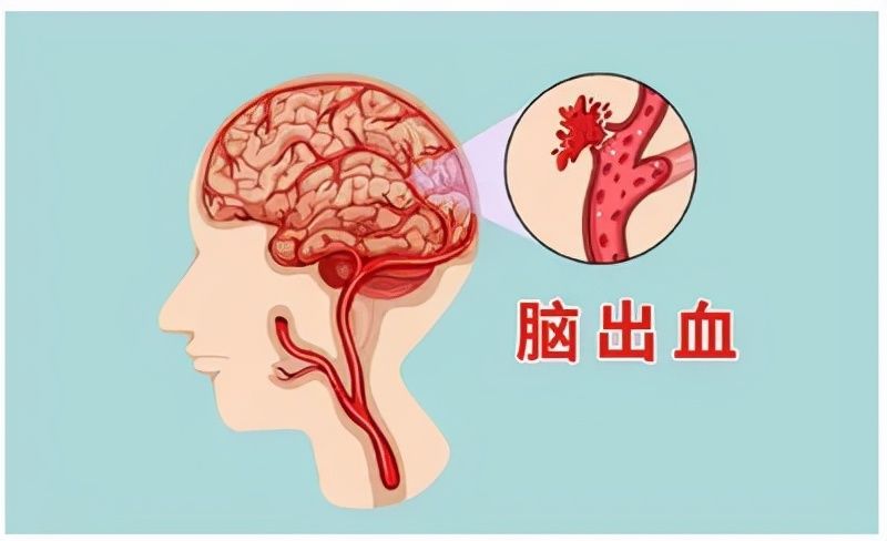 维甲酸|男子高烧乏力查出特殊的白血病，幸好没做化疗！医生：这种病治疗另有门道