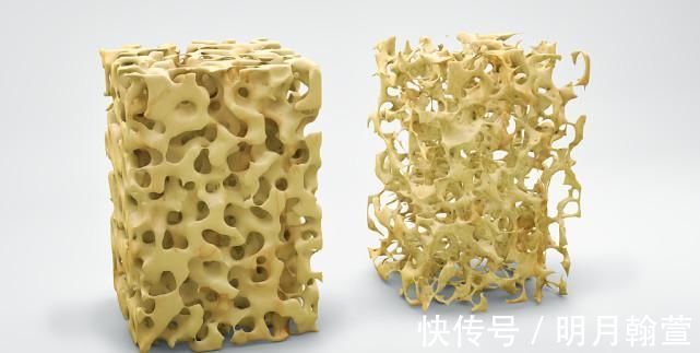 骨密度|骨科医生：不论男女，睡前3个好习惯，增加骨密素，远离骨质疏松