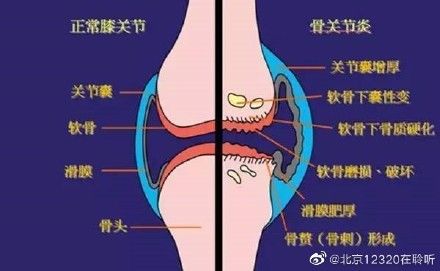 保守治疗|上了年纪总是膝盖痛，保守治疗有哪些手段？