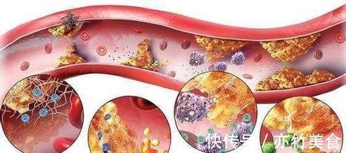 血管|甘油三酯的“头号强敌”发现,没事喝两口,血管畅通,血栓绕道走