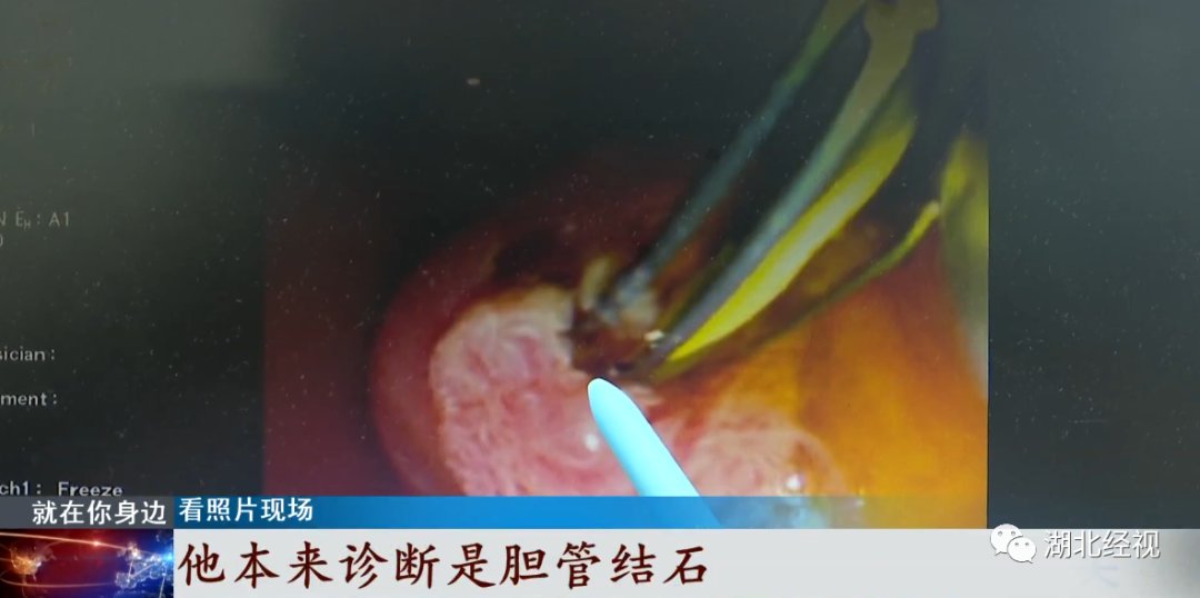 佳木斯|男子体内出现大量活寄生虫!和这种饮食习惯有关