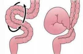 饭后|饭后剧烈运动，饭后一动不动，都能造成肠梗阻？