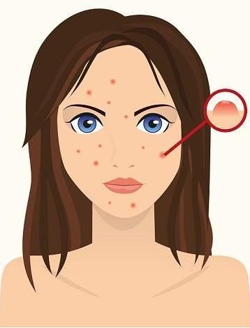 明星也会的护肤技巧，两分钟学会祛痘不留疤