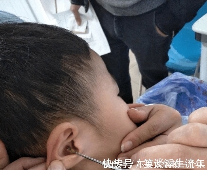 耳朵|孩子生下来就没掏过耳朵,又长又宽的耳屎堵住耳道,家长需警惕