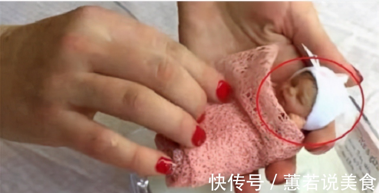 磨难|生命奇迹!“世界最小婴儿”出生仅25厘米,如今18岁的她怎样了
