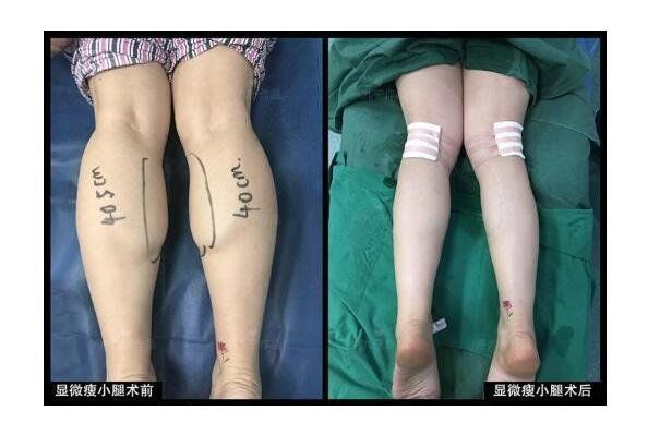 精灵|川台评论丨注射耳朵阻断神经 自残式整形令人心惊