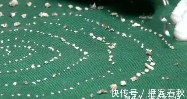 怪物|七岁男孩嘴中有526颗牙齿,医生花费5小时取出,和怪物没区别