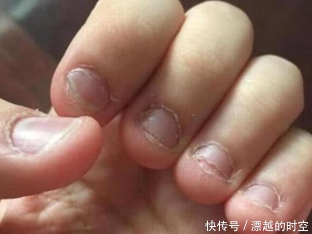 孩子|从小爱“咬指甲”的孩子,医生坦言长大后,多半逃不过两种结局