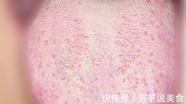 肝脏|肝硬化走来,记准“1痒2黄3舌”,肝脏“求救”,别当看不见