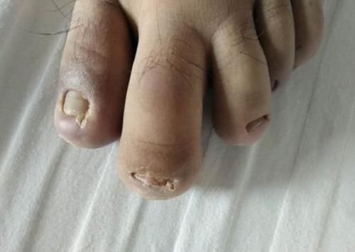 血糖|糖尿病还有“假”？建议：若有这3种情况，就是”假性糖尿病“！