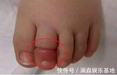 截肢|宝爸宝妈们,这些东西你家都有,它可能会导致宝宝面临截肢!