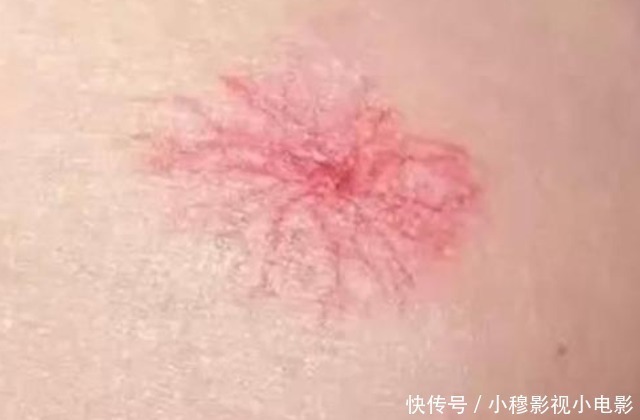 蜘蛛痣|肝变“硬”和吃面条有关?医生坦言:养肝护脏,这2种食物要远离